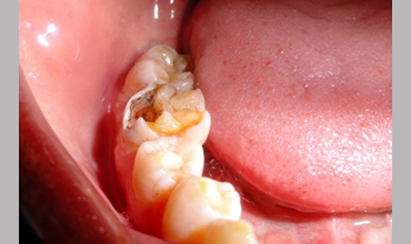 cosmetic dentistry treatment in Anand
                        